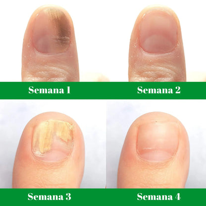 Terbinafina En Gotas Para Hongos En Tus Uñas