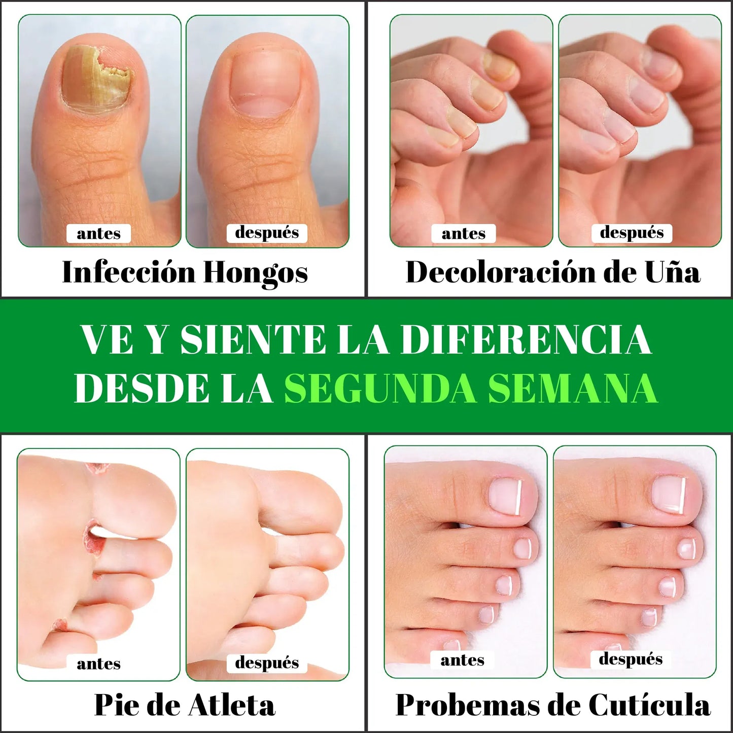 Terbinafina En Gotas Para Hongos En Tus Uñas